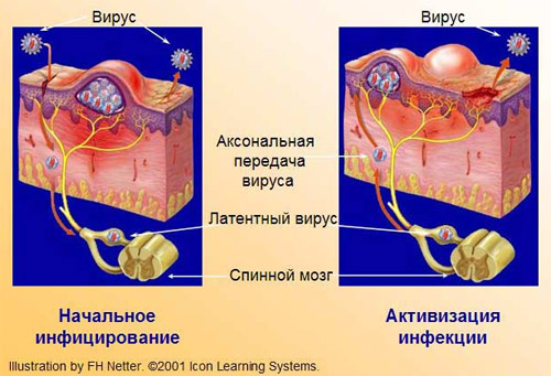 Механизм развития генитального герпеса (герпесвирусной инфекции)