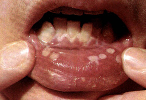 Герпес: первичная инфекция-герпетический стоматит. Множественные очень болезненные эрозии на слизистой нижней губы.