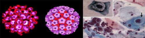 Вирусы папилломы человека - ВПЧ, Human papillomavirus - HPV