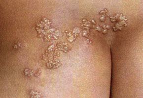 Опоясывающий лишай: поражение одного дерматома. Возбудитель – вирус varicella-zoster.