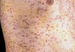 Опоясывающий лишай на фоне иммунодефицита: диссеминированное поражение кожи.